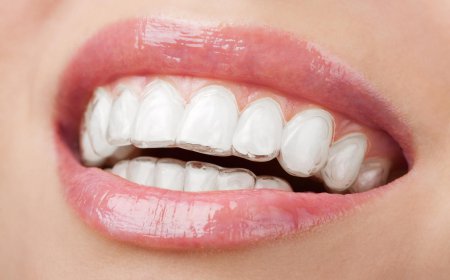What Are Braces?