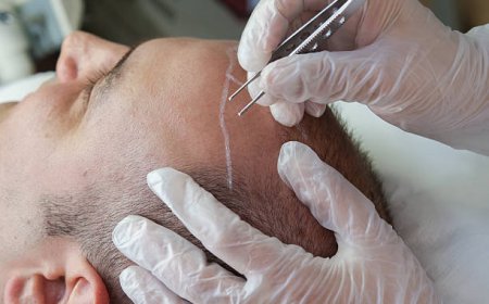 Hair Transplant in Dubai: A Long-Term Investment