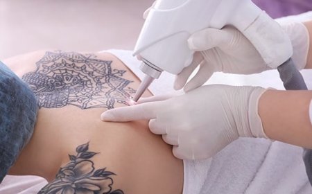 Why Is PicoSure Used for Tattoo Removal?