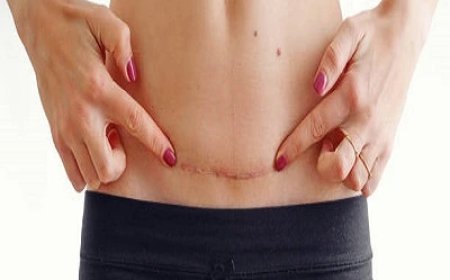 When Is Surgical Scar Revision Needed for Old Scars?