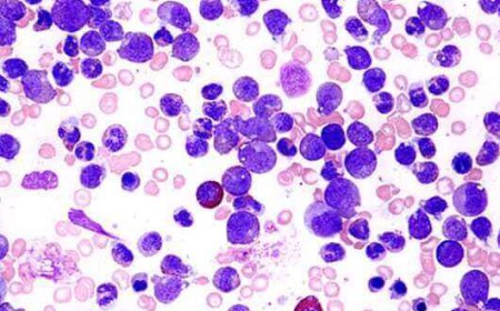 Chemotherapy Induced Neutropenia Market Size, Trends, and Growth Outlook 2026-2033