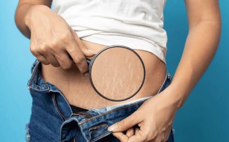 Best Stretch Marks Removal Treatments That Really Work