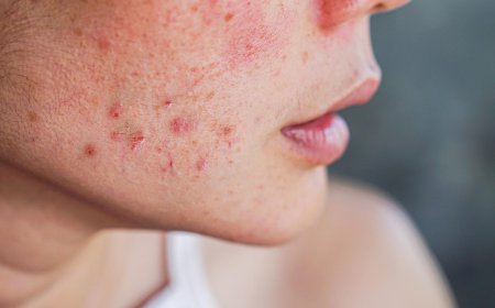 Why Is Acne Treatment Important for Skin Health?