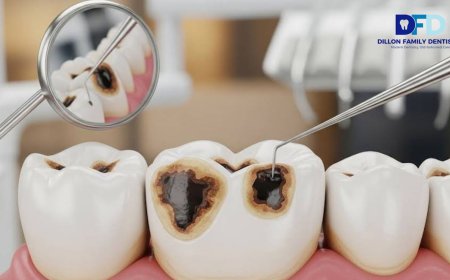 Black Spot on Tooth? Bryn Mawr Family Dentist Explains
