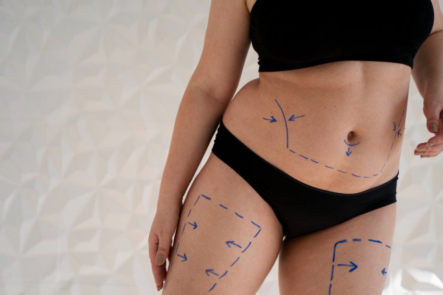 Liposuction in Dubai: Pain, Recovery, and Results Timeline Explained