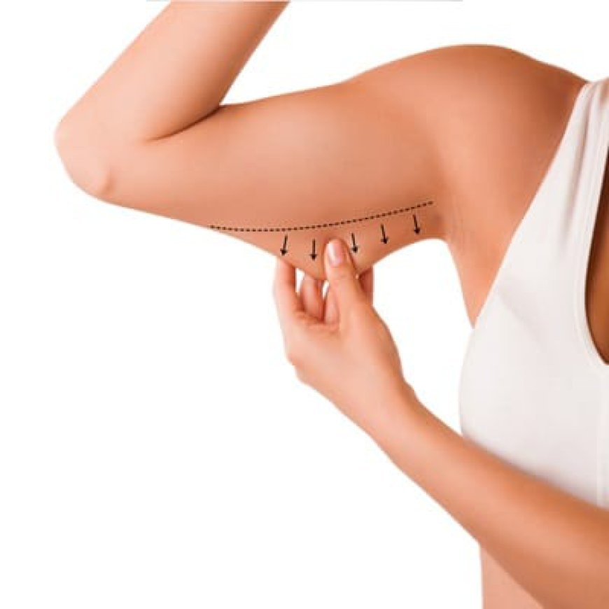 Who Is an Ideal Candidate for Arm Lift Surgery?