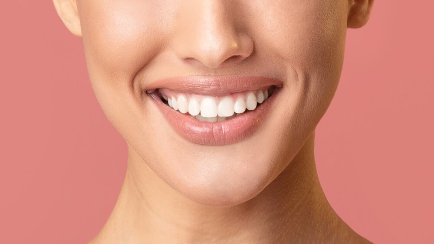 What Are Composite Veneers and How Do They Work?