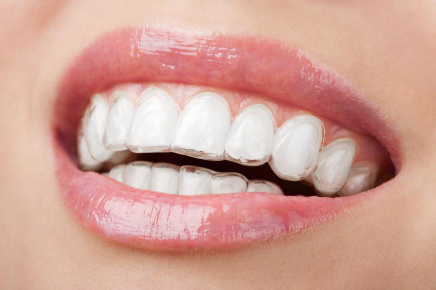 What Are Braces?