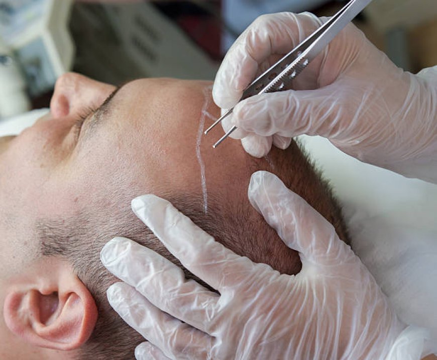 Hair Transplant in Dubai: A Long-Term Investment