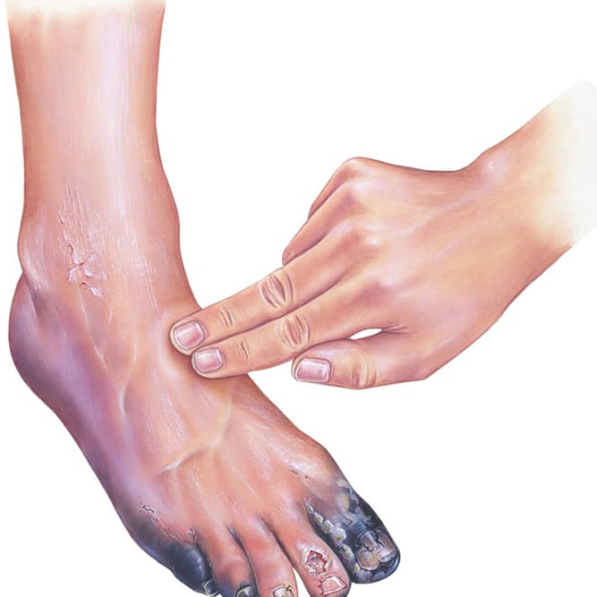 Peripheral Artery Disease (PAD) Market Growth and Future Outlook