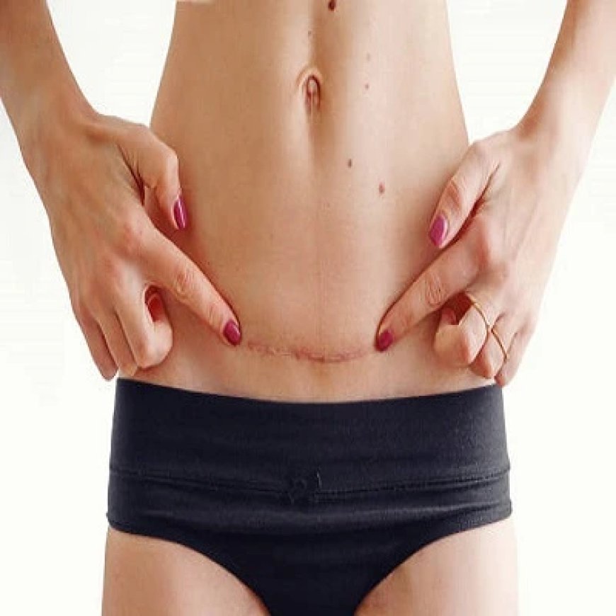 When Is Surgical Scar Revision Needed for Old Scars?