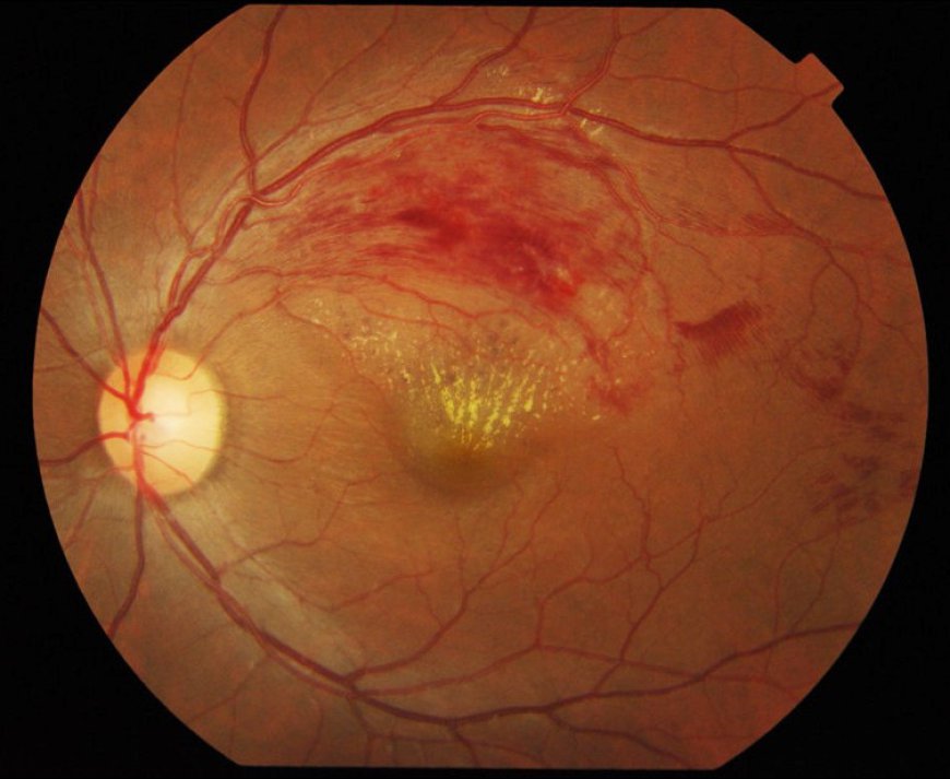 Retinal Vein Occlusion Market Size, Trends, and Strategic Outlook 2026-2033