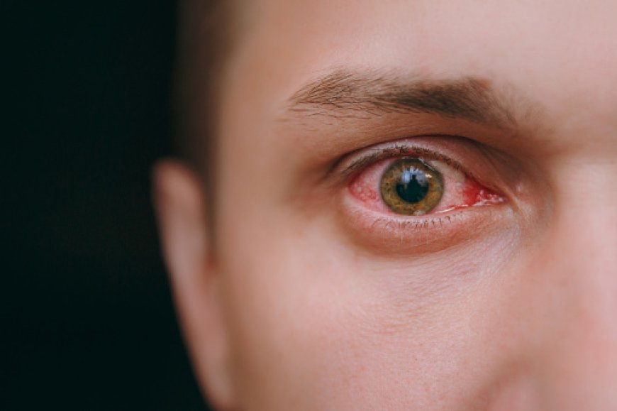 Thyroid Eye Disease (TED) Market: Size, Trends, and Growth Outlook 2026-2033