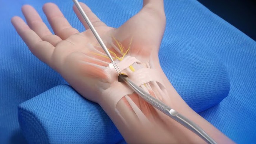 Carpal Tunnel Release System Market: Size, Growth, Trends, and Strategic Insights