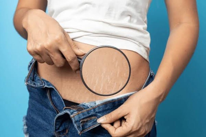 Best Stretch Marks Removal Treatments That Really Work