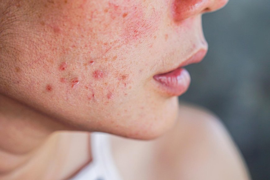 Why Is Acne Treatment Important for Skin Health?