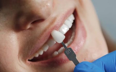 Dental Veneers Before and After: Complete Guide