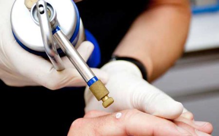 Is Cryosurgery Commonly Used for Skin Lesions?