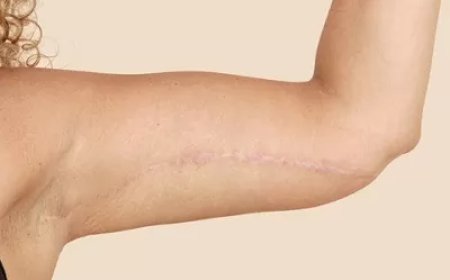 Who Is the Best Candidate for Arm Lift Surgery?