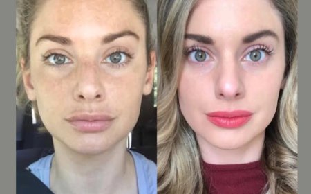 Radiofrequency (RF) Microneedling in Dubai as a Non-Surgical Skin Solution