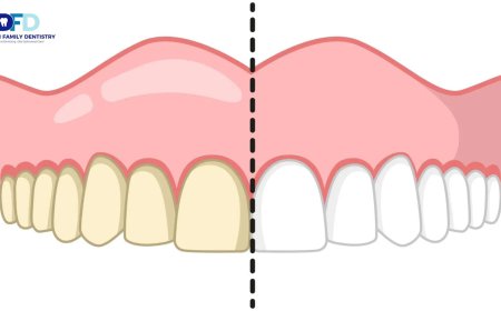 Teeth Whitening Sensitivity: Is It Permanent? | Bryn Mawr