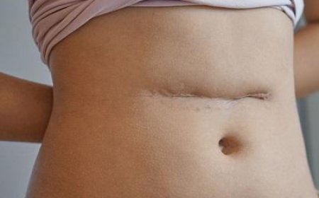 Who Can Benefit from Surgical Scar Revision?