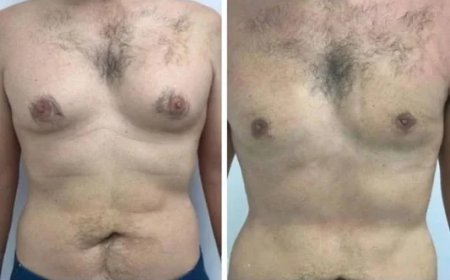 Best Gynecomastia Surgeons in Dubai: Understanding the Procedure, Recovery, and Results