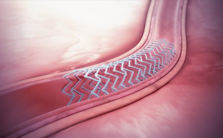Global Bioabsorbable Stents Market Size, Trends, and Growth Forecast 2026-2033
