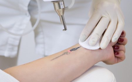Is Modern Laser Tattoo Removal a Safe Procedure?