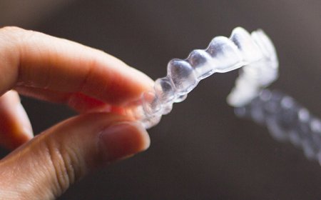 Common Questions About Clear Braces on Teeth