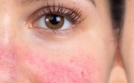 Can Rosacea Treatment Reduce Facial Redness?