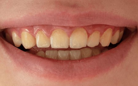 Teeth Whitening in Bryn Mawr | Dillon Family Dentistry