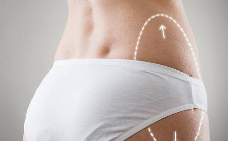 How Does Vaser Quad Liposuction in Dubai Work?