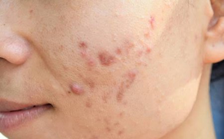 How Does Acne Treatment Help Improve Skin Clarity?