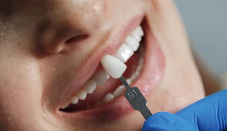 Dental Veneers Before and After: Complete Guide