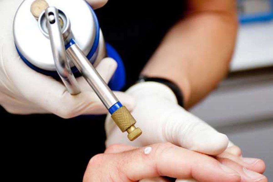 Is Cryosurgery Effective for Removing Skin Tags?