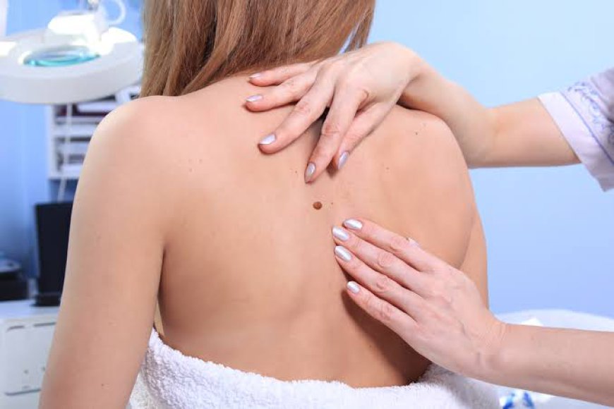 What Is the Best Moles Removal Treatment?