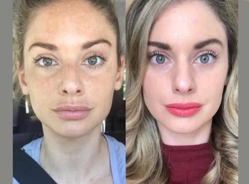 Radiofrequency (RF) Microneedling in Dubai as a Non-Surgical Skin Solution