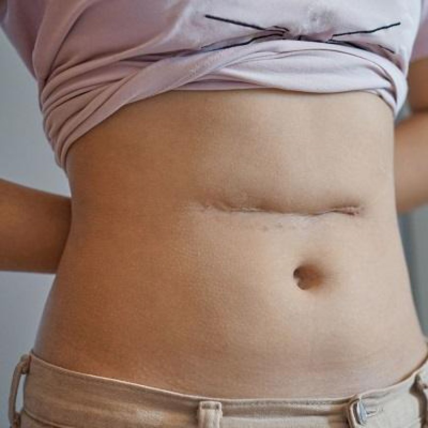 Who Can Benefit from Surgical Scar Revision?