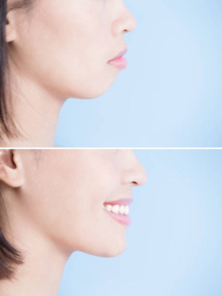 Top Chin Augmentation in Dubai for Lasting Results