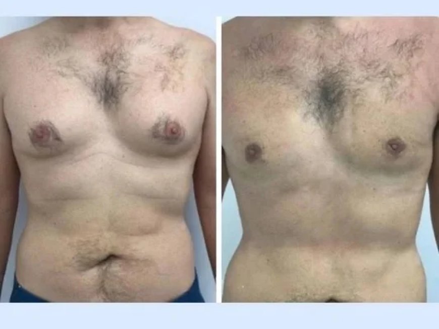 Best Gynecomastia Surgeons in Dubai: Understanding the Procedure, Recovery, and Results