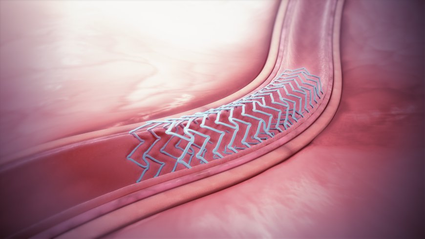 Global Bioabsorbable Stents Market Size, Trends, and Growth Forecast 2026-2033