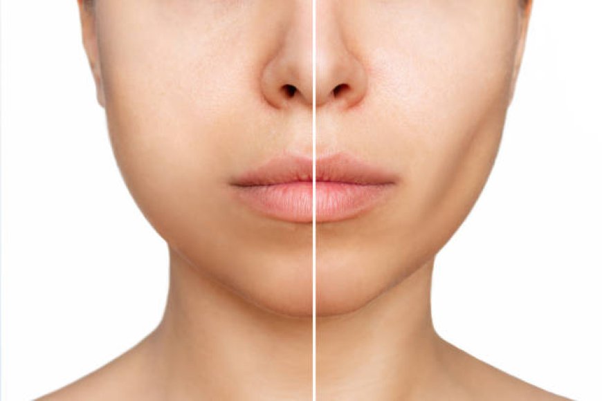 Buccal Fat Removal in Dubai for a V-Shaped Face