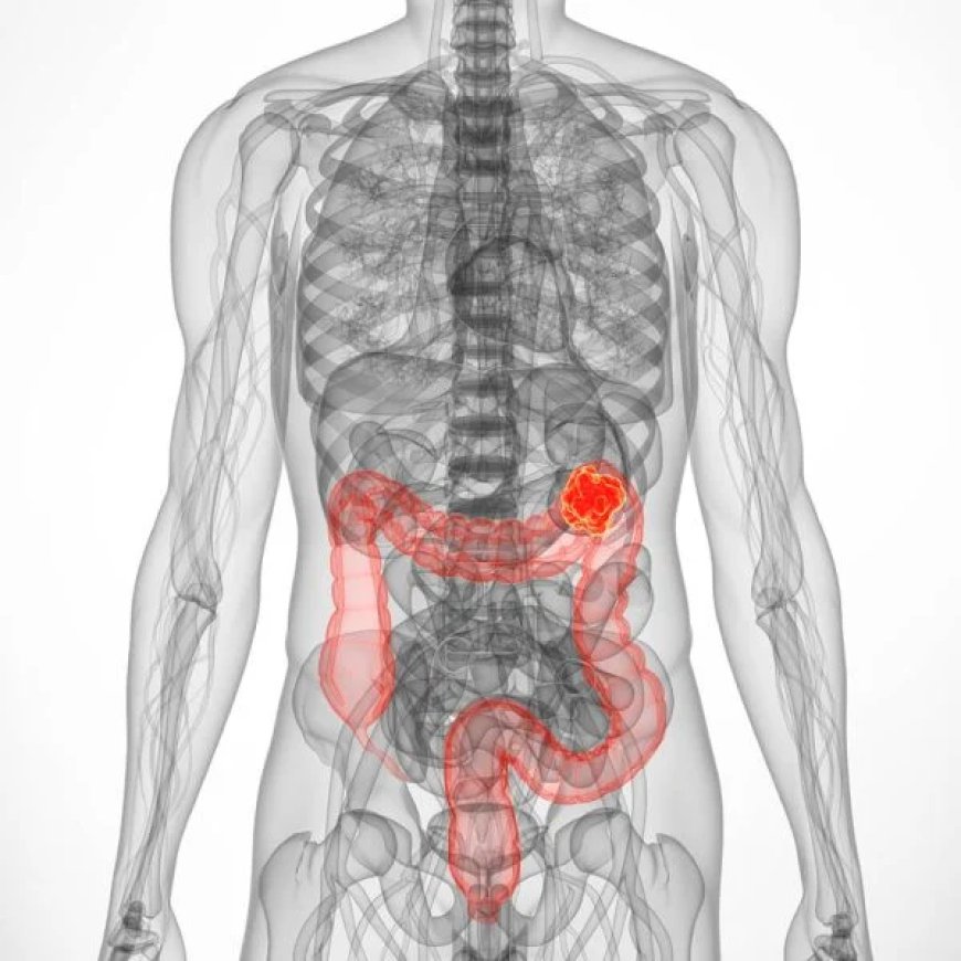Metastatic Colorectal Cancer Market Size, Trends, Growth, and Forecast 2026-2032