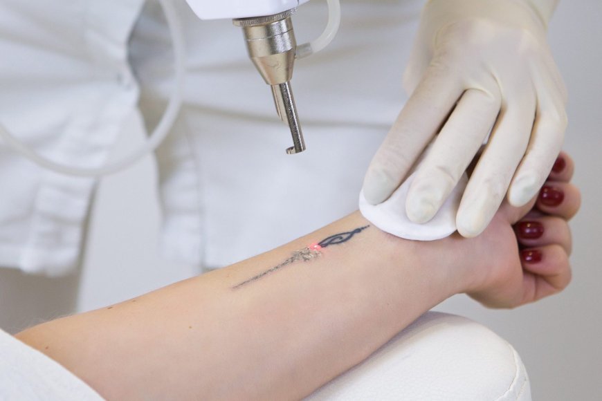 Is Modern Laser Tattoo Removal a Safe Procedure?