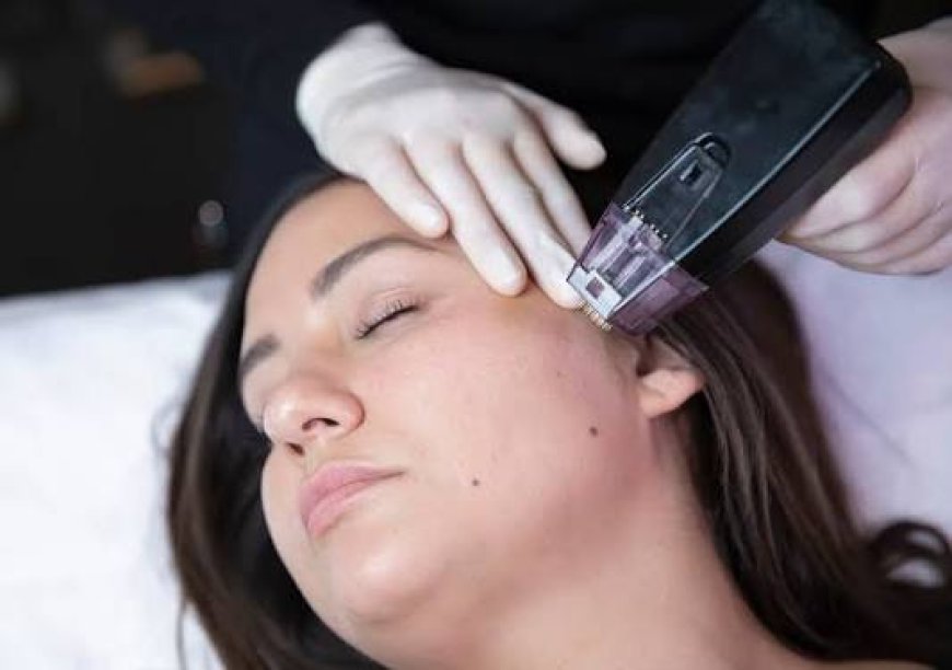 Restore Skin Firmness and Glow with Morpheus8 Treatment