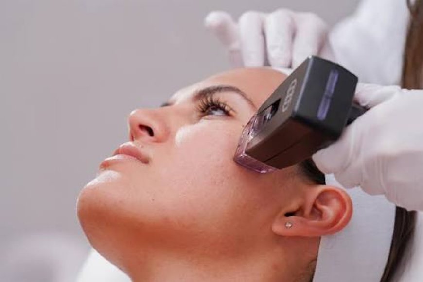 Morpheus8 for Stretch Marks: Is It Effective?