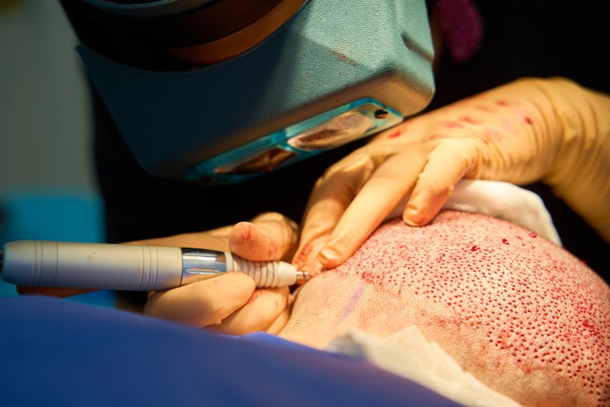 Who Is the Right Candidate for a Hair Transplant Procedure?