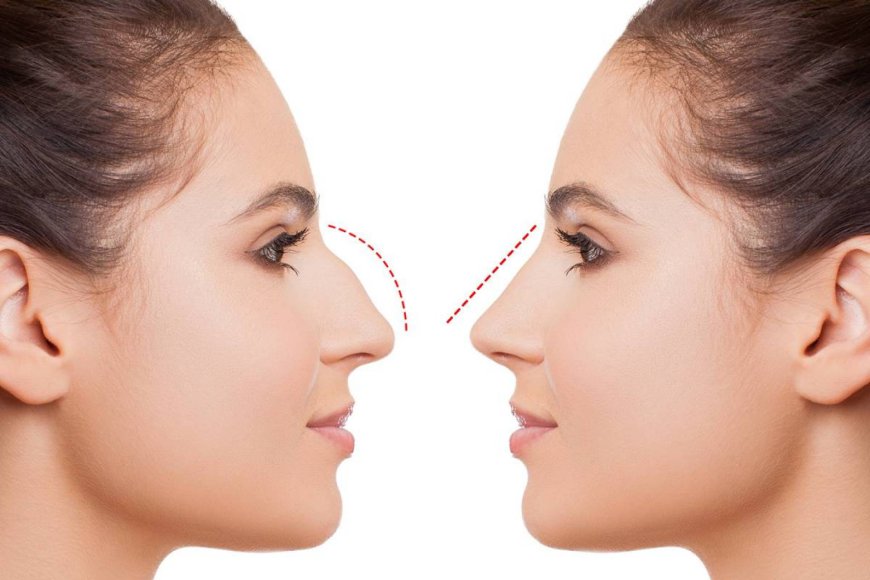 The Role of Facial Proportion Analysis in Successful Rhinoplasty Results