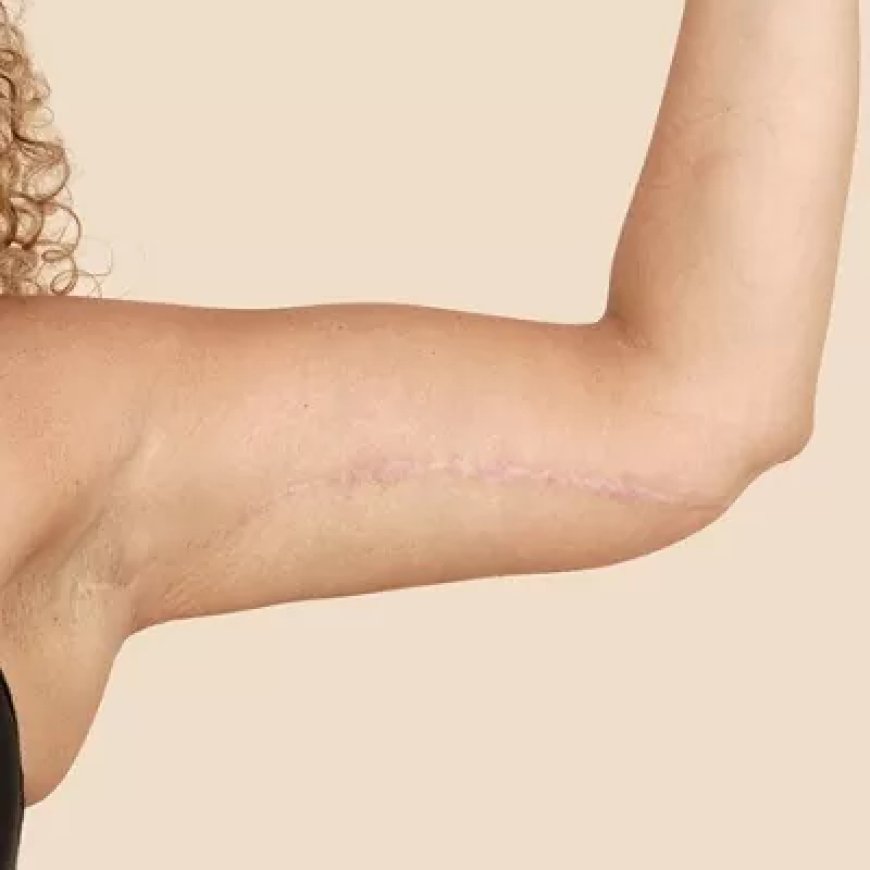 Who Is the Best Candidate for Arm Lift Surgery?